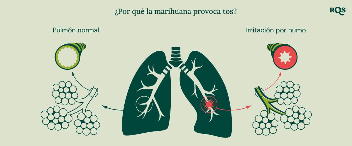 Diagrama del pulmón sano vs. pulmón irritado con inflamación y bronquios hinchados causados por fumar marihuana.